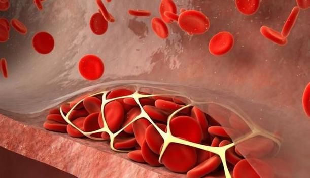 血栓最怕的2个小动作,没事动一动,化解血栓,“疏通”血管