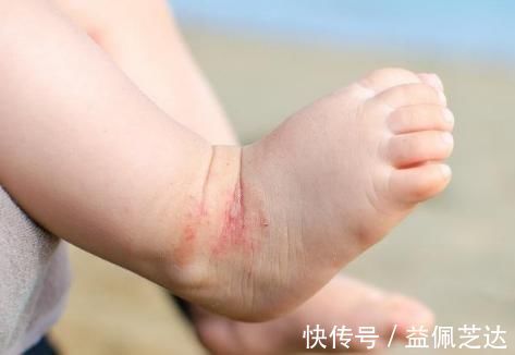 丘疹|婴儿“湿疹”可分为3种类型，症状虽然各有不同，需正确区分了