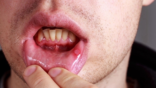 肝硬化|身上有“2多1少”，说明肝脏很健康，肝硬化、肝癌离你很远