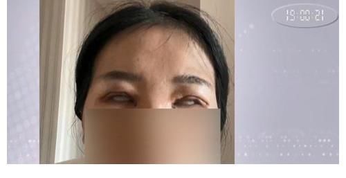 手术 28岁女子做双眼皮手术“眼睛变成白眼” 老公天天闹离婚