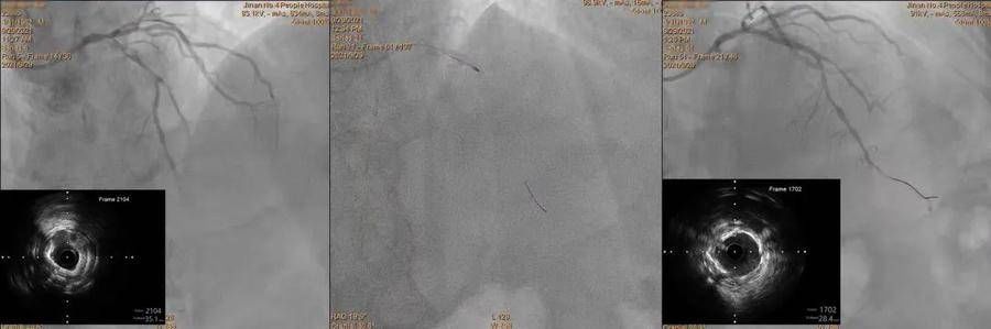 金刚钻|济南市第四人民医院“金刚钻”解决冠脉严重钙化狭窄病变