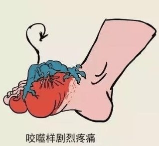 症状|高尿酸是诱发痛风的前提，两个方法教你稳住！