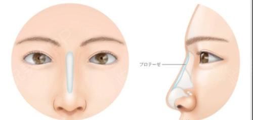 你去隆鼻之后 术后鼻部歪斜你会怎么办？