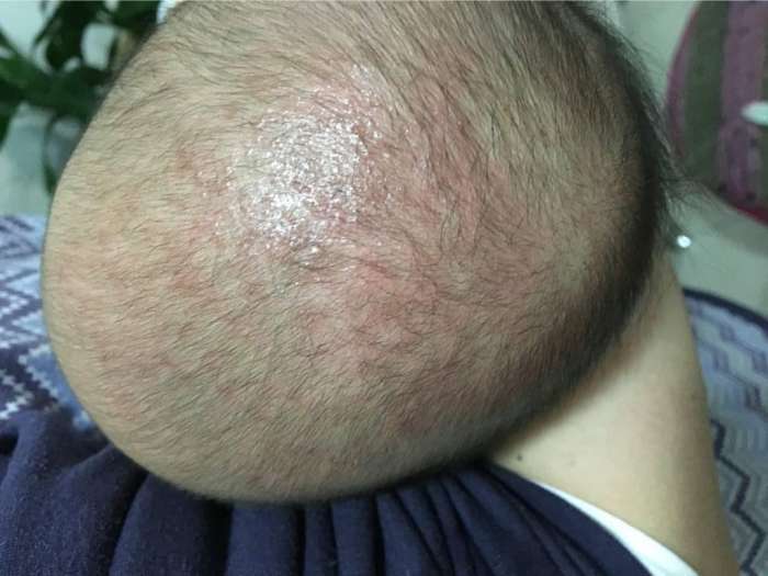 宝宝|刚满月的宝宝就高烧不退!医生看到宝宝的头皮后怒斥她不配做妈妈