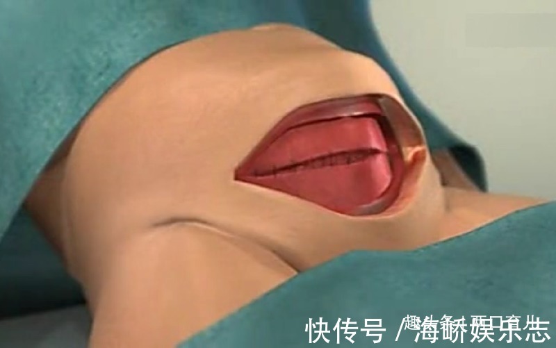 两者|剖腹产横切和竖切都一样别小看这一刀,两者效果大不相同