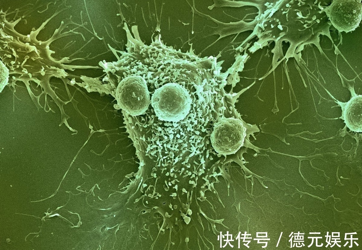 切除|手术三个月就发生转移原因解析,医生提示,术后2年是癌症转移期