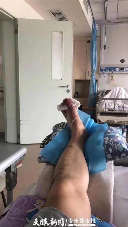 剔骨|男子痛风发作用剔骨刀割下块肉，结果险些脚趾不保