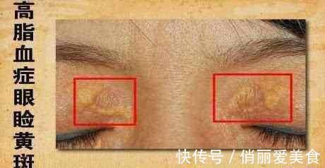 血脂异常|多走路可以降血脂?专家提醒:过了50岁,这3事或比运动更有效