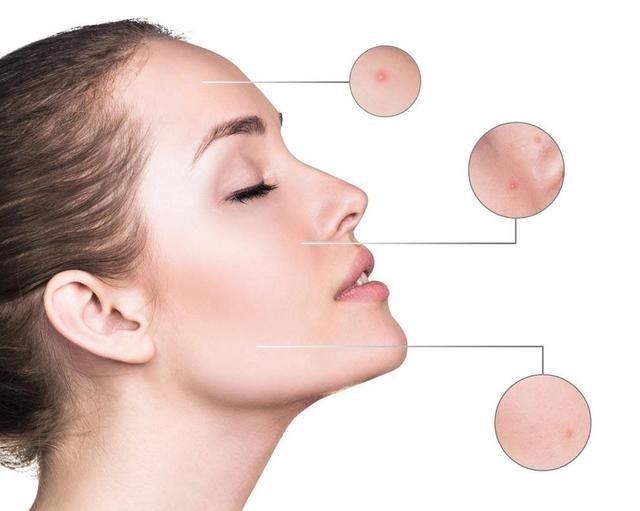 激素脸|为什么很多女生不护肤反而皮肤更好?坚持做这3件事,皮肤都不差