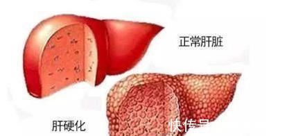 代谢|当肝硬化“扎营”身体时,会露出4个马脚,医生:多留点心