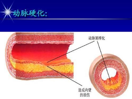 【草丁图书馆】出现动脉硬化身体会发出一系列信号,切不可疏忽大意!