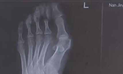 王女士 爱穿高跟鞋的女性一定要小心,拇指外翻堪比“裹脚”!不可忽视