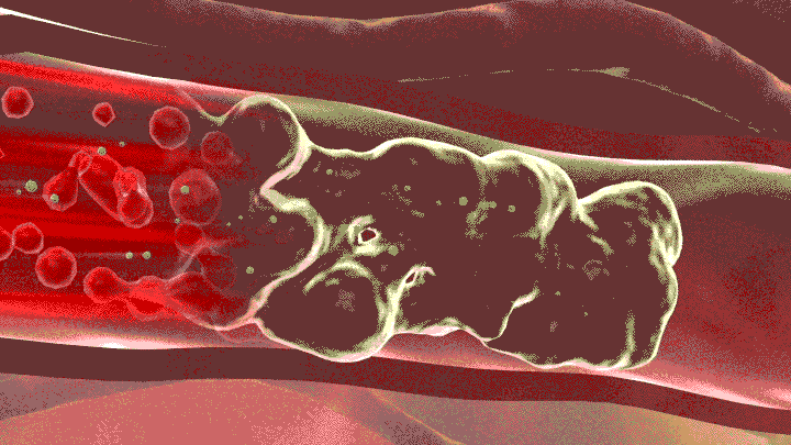 病变|世卫组织曝光：“它”或比油和盐更伤血管，越早知道越好