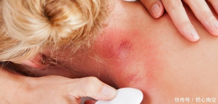 刮痧刮出“一片红”,是身体在排毒吗针灸科主任给出解释!