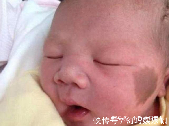 产科医生|胎记是怎么来的?妇科医生:除了遗传,孕期尽量避开这3种行为