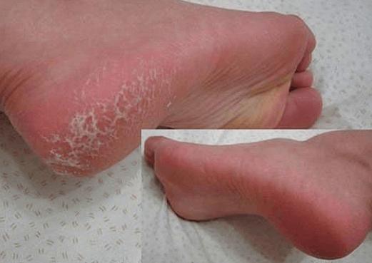 脚上老皮、老茧又干又硬!一个民间小秘方学会,双脚变的白白嫩嫩