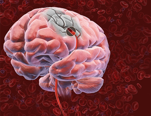 脑血管|“中风”为何越来越多直言改掉饭后3个习惯,脑血管会更健康