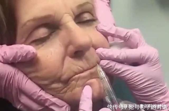 神奇|玻尿酸到底多神奇80岁外国老奶奶亲自实验,一小时后惊艳全场!