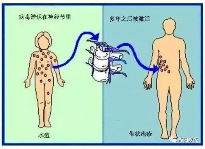 疾病|秋冬季带状疱疹要早防！专家提醒：可接种疫苗预防