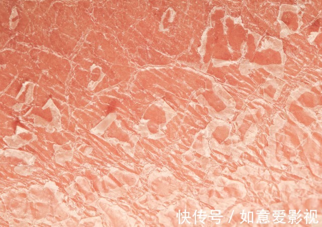 皮肤|肺癌来袭，皮肤先知！医生教你：如何通过看皮肤，判断患有肺癌