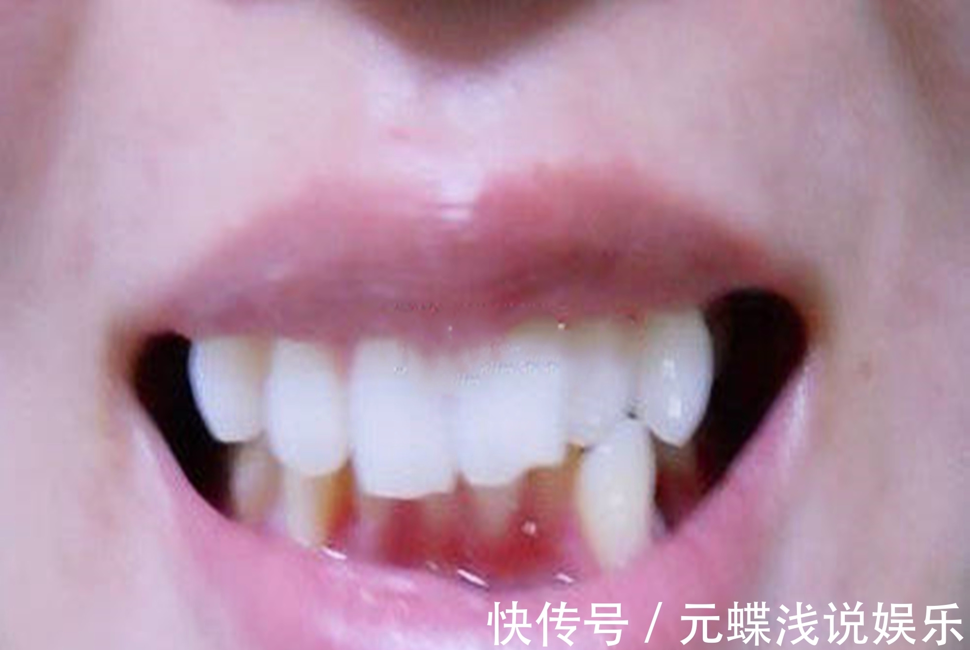 宝宝|好不容易等到宝宝换牙期,新牙却长歪了?医生:家长无知惹得锅