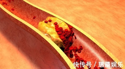 血脂|血脂高的人,多观察手指,若没这几个异常,说明脑梗离你还很远