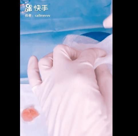 手术|给火龙果割阑尾33岁水果医生爆红吸粉90万网友看到第一个就痛了