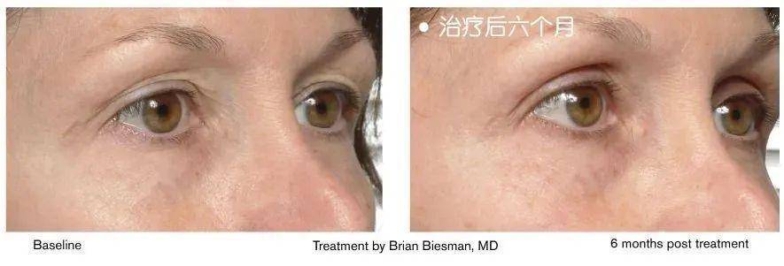 真皮层 热玛吉做完之后皮肤会不会加速衰老?不同年龄段做了热玛吉都会有什么改变?