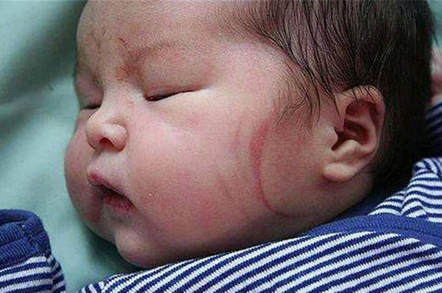 营养均衡|1岁宝宝“产钳印”未消退,宝妈上医院讨说法,医生的话让她羞愧