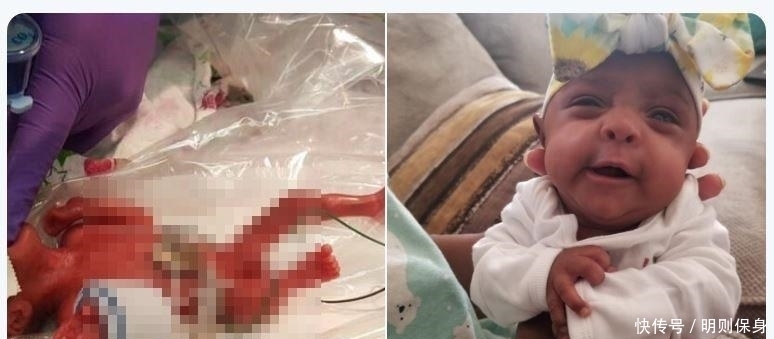 孕妇|全球最小“婴儿”体重245克，比手掌还小，6个月过去了现状如何？