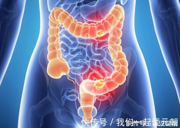 大便|排便莫名出现4种征兆,或暗示大肠癌易上身,趁早检查,别忽视
