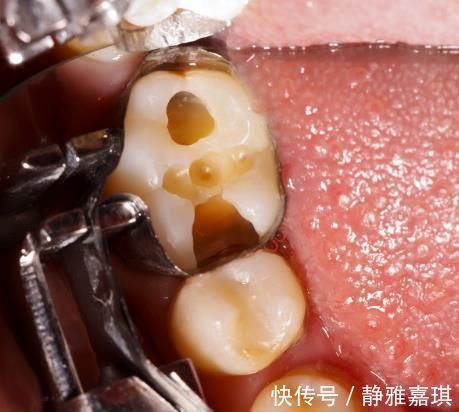 牙齿|10个5岁儿童中,7个有龋齿,罪魁祸首居然不是糖?