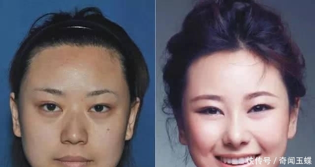 双眼皮|实拍：10张女孩整容前后的对比照，这真就是换了一张脸