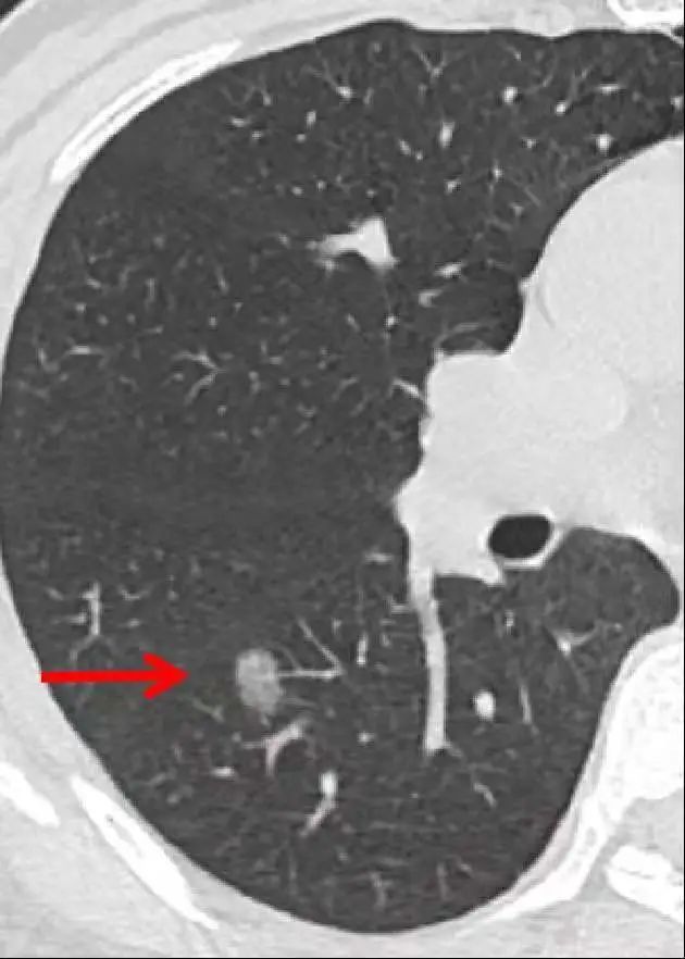 yyds|YYDS！关于肺结节，看这篇就够了