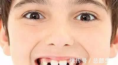 牙科医生|15岁男孩长出“尖牙”,妈妈亲手摸过后吐槽:养了个“吸血鬼”