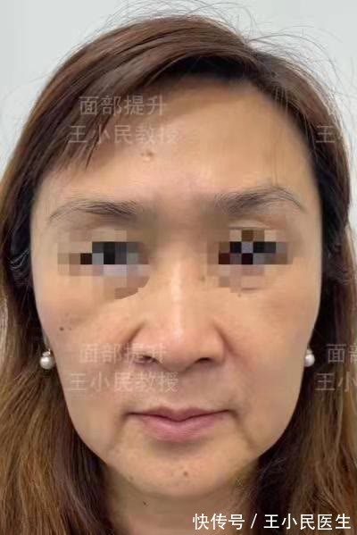 颧骨 王小民教授:做了小拉皮之后,她的脸型竟有如此大的改变!