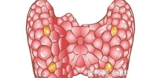 食物|甲状腺结节患者，多吃这3种食物，化瘀散结，结节慢慢就消失了！