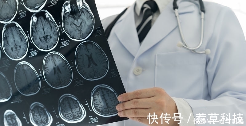 颅窝肿瘤|咳嗽也会咳到头痛！合并4种症状小心是脑部有病灶