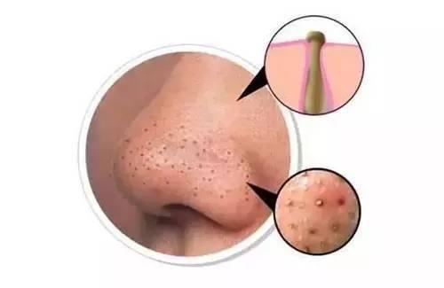 毛孔 黑头怎么去除最有效,坚持这6个护肤方法科学有效去黑头