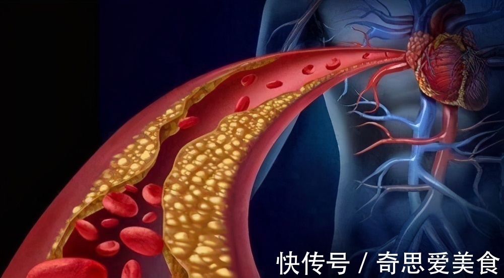 钠盐|高血压不吃药,如何降血压?医生告诉你这6个方法,简单又实用