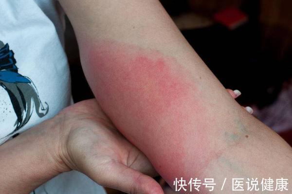 发作|荨麻疹进入晚上后,症状会加重,或与这6个因素有关,需重视