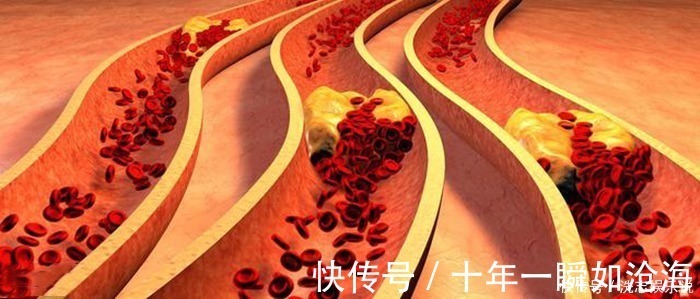 导管|血管支架能穿进人的血管，为何不直接用支架把血管里的血栓吸出