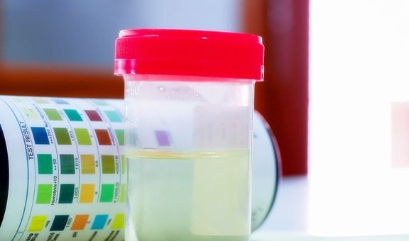 血糖|糖尿病患者的尿又黄又骚是什么原因？你真的知道吗？看专家的理解