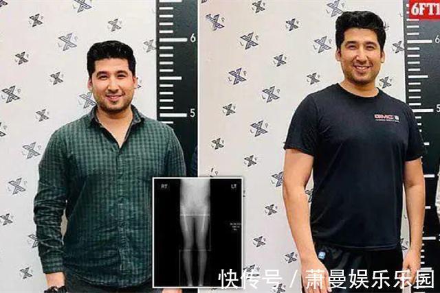 身高|男子花费58万“拉骨”,只为增高5厘米,网友们大呼无法理解