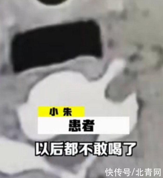 医生|小伙嘴开可乐瓶盖冲进食管！医生一句话让他崩溃：再也不敢喝了