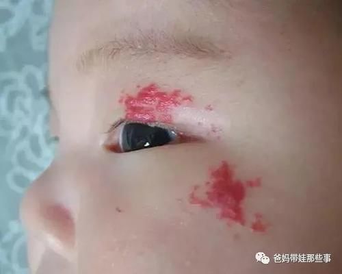 宝宝额头长“胎记”，竟是血管瘤，孕妈妈怎样预防？