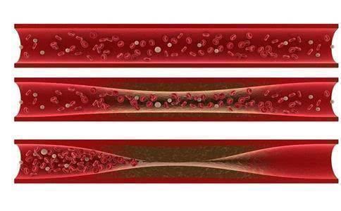 泡水|人到中年，血管堵塞，坚持用1种水果泡水喝，10天疏通血管