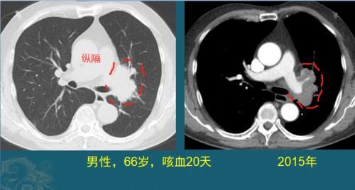  治愈的病|生存期长的癌症有哪些？医生用CT片举例，至少3类