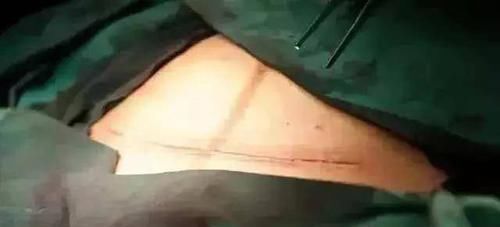 医生|顺产先苦后甜,剖腹产先甜后苦,而选择剖腹产的孕妈,这8种痛逃不掉