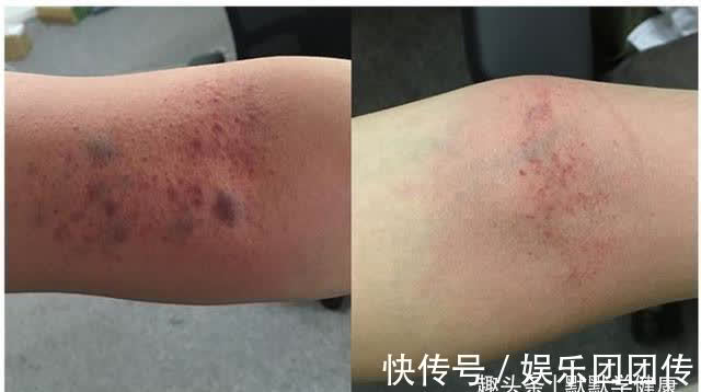 桂圆肉|伏天是补阳、祛痰湿的好时机,这3招,阳虚、痰湿重的人别错过!